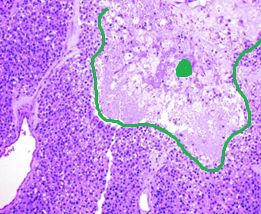 PDTC. Outline and dot highlight the focus of necrosis (Courtesy Dr. V. Penopoulos)