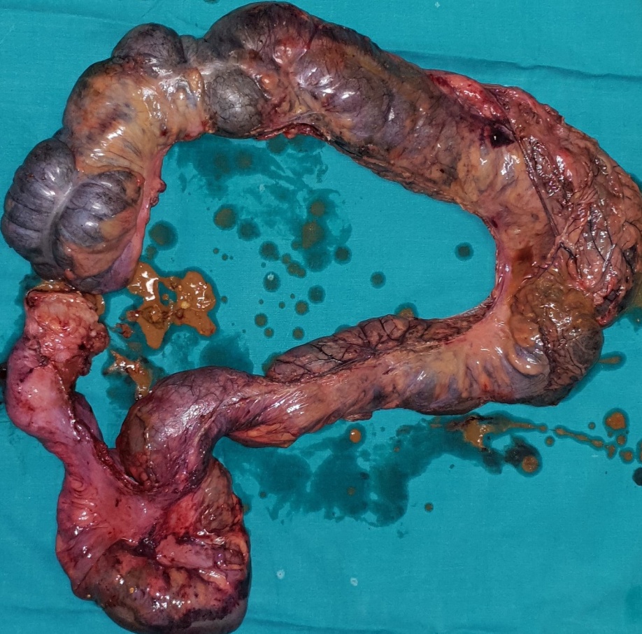 Παρασκεύασμα μετά από υπολική κολεκτομή (Ευγενική παραχώρηση Dr. V. Penopoulos)