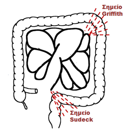Πλήρης ισχαιμία του παχέος εντέρου (Ευγενική παραχώρηση Dr. V. Penopoulos)