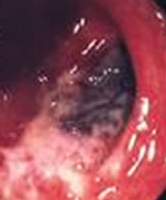 Παρασκεύασμα μετά από υπολική κολεκτομή (Ευγενική παραχώρηση Dr. V. Penopoulos)