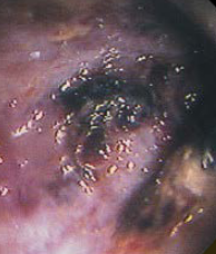 Παρασκεύασμα μετά από υπολική κολεκτομή (Ευγενική παραχώρηση Dr. V. Penopoulos)