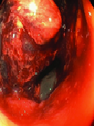 Παρασκεύασμα μετά από υπολική κολεκτομή (Ευγενική παραχώρηση Dr. V. Penopoulos)