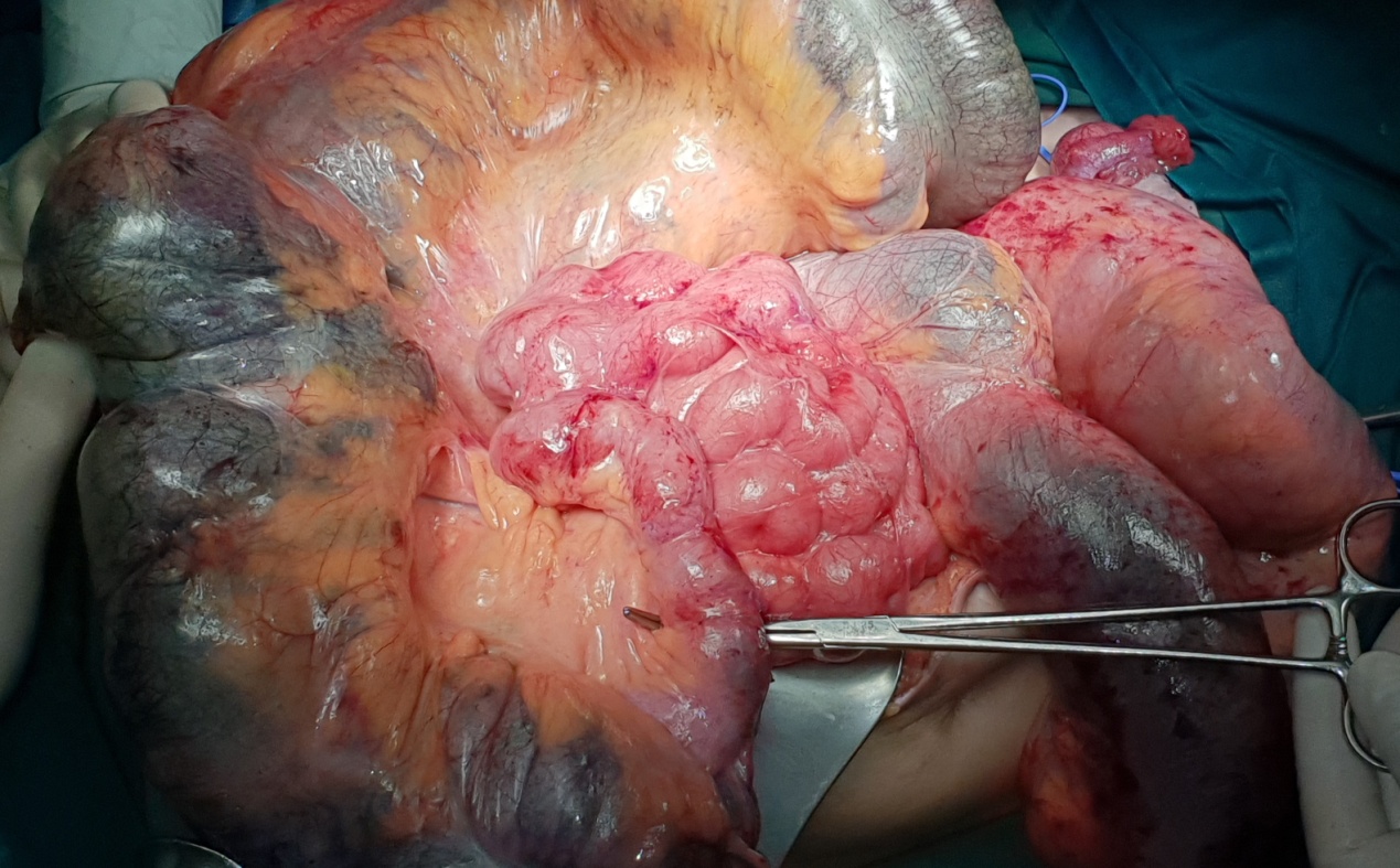 Παρασκεύασμα μετά από υπολική κολεκτομή (Ευγενική παραχώρηση Dr. V. Penopoulos)