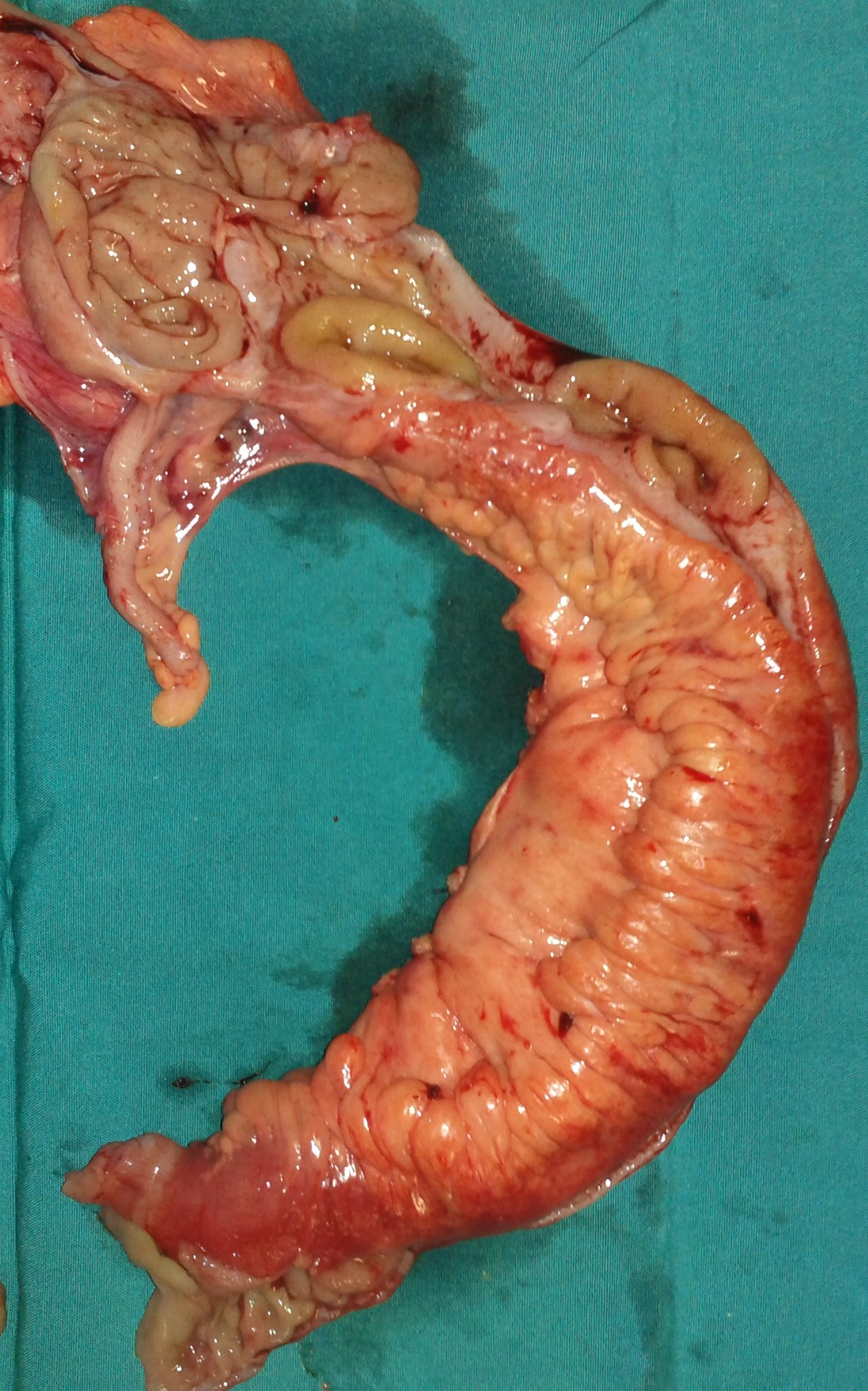 Παρασκεύασμα μίνι δεξιάς ημικολεκτομής (Ευγενική παραχώρηση Dr. V. Penopoulos)