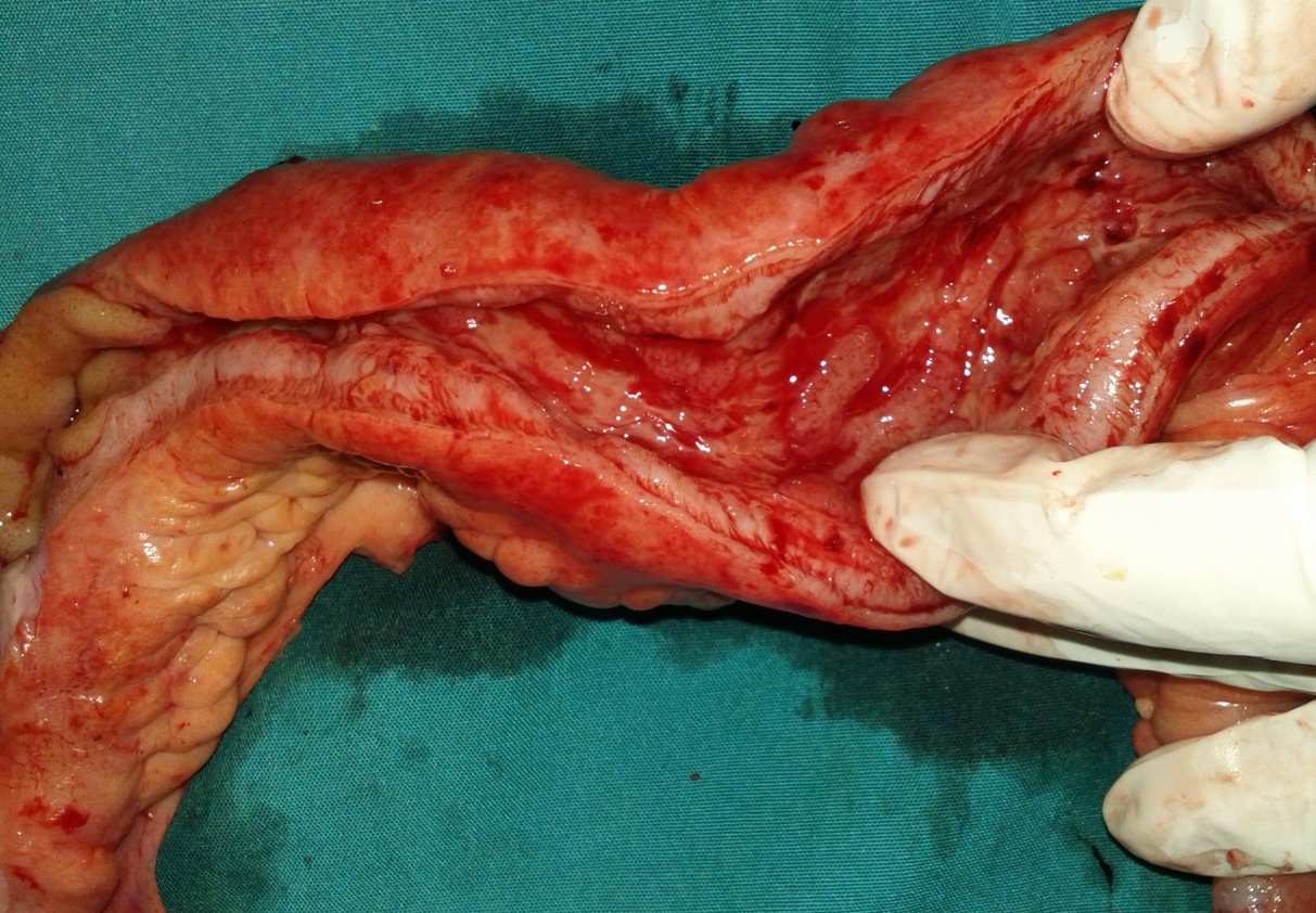 Η στένωση του τερματικού ειλεού διακρίνεται ανάμεσα στα δάκτυλα του χειρουργού (Ευγενική παραχώρηση Dr. V. Penopoulos)