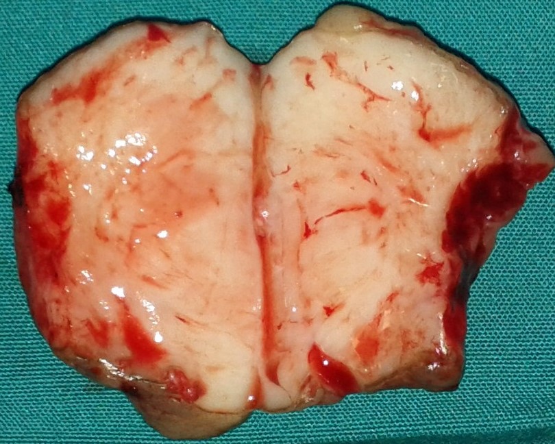 Το εξαιρεθέν ίνωμα. Παρατηρείται λευκή, ομοιογενής, ινώδης μάζα (Ευγενική παραχώρηση Dr. V. Penopoulos)
