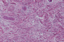 Μικροσκοπική εικόνα μετά από χρώση αιματοξυλίνης-ηωσίνης, που αναδεικνύει ινώδη συνδετικό ιστό χωρίς ατυπία, ομοιάζοντας με δερματικό ίνωμα (Ευγενική παραχώρηση Dr. V. Penopoulos)