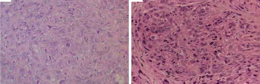 Επιθηλιοειδή κύτταρα με μέτριο πλειομορφισμό, ηωσινόφιλο κυτταρόπλασμα, εμφανή κυστικά πυρήνια, σπάνια ραβδοειδή κύτταρα και υαλώδεις εγκλεισμούς στο κυτταρόπλασμα που εκτοπίζουν εκκεντρικά τους πυρήνες (Ευγενική παραχώρηση Dr. V. Penopoulos)