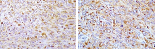 Επιθηλιοειδή και ραβδοειδή κύτταρα που παρουσιάζουν θετικότητα για βιμεντίνη και κυτοκερατίνη (Ευγενική παραχώρηση Dr. V. Penopoulos)