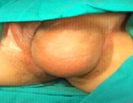 Γιγαντιαίος κυστικός όγκος αιδοίου (Ευγενική παραχώρηση Dr. V. Penopoulos)