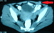 Χειρουργικά παρασκευάσματα εξαιρεθέντων ενδομητριωμάτων (Ευγενική παραχώρηση Dr. V. Penopoulos)