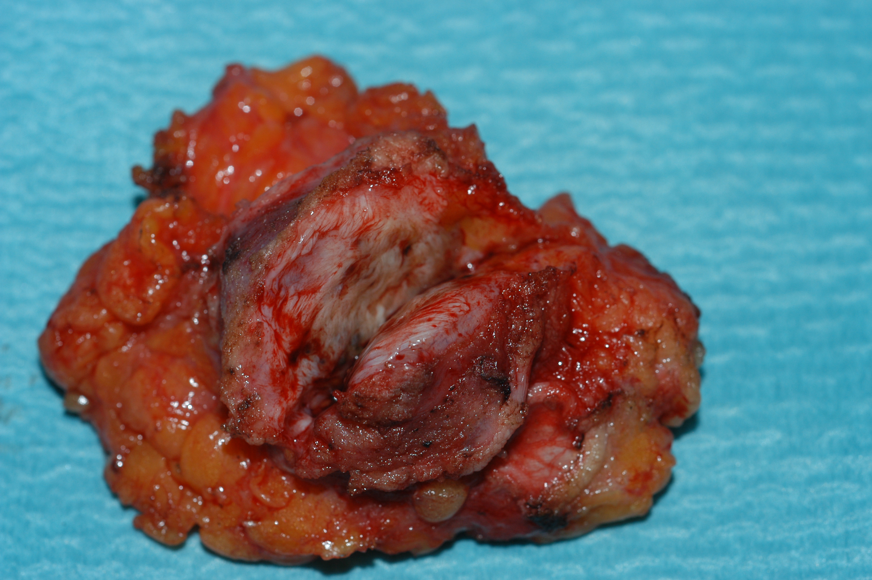 Χειρουργικά παρασκευάσματα εξαιρεθέντων ενδομητριωμάτων (Ευγενική παραχώρηση Dr. V. Penopoulos)