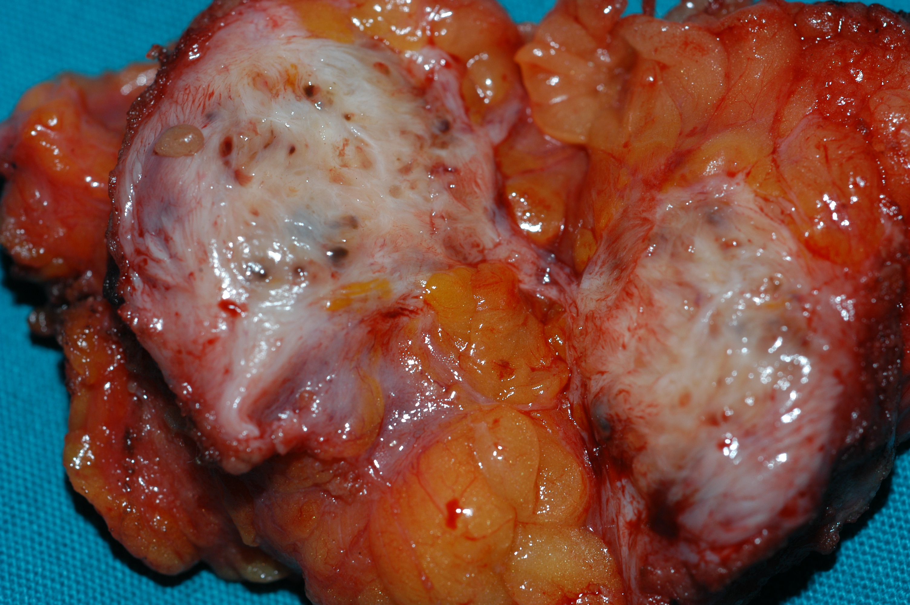 Χειρουργικά παρασκευάσματα εξαιρεθέντων ενδομητριωμάτων (Ευγενική παραχώρηση Dr. V. Penopoulos)