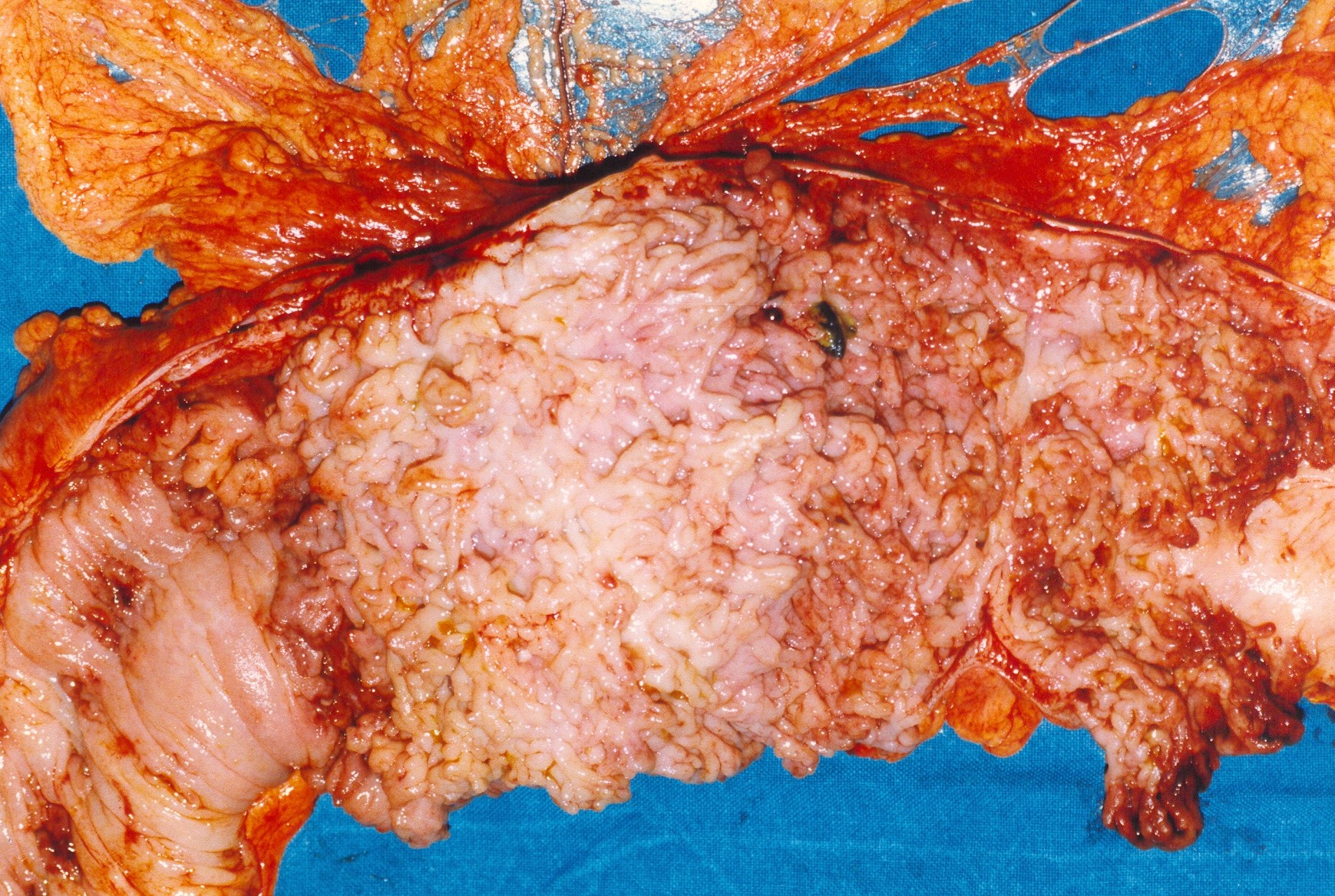 Λεπτομέρεια των εκτεταμένων βλαβών στο εγκάρσιο κόλον (Ευγενική παραχώρηση Dr. V. Penopoulos)