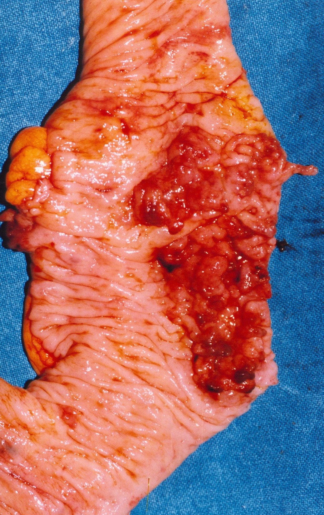 Χαρακτηριστικές βλάβες του κατιόντος κόλου (Ευγενική παραχώρηση Dr. V. Penopoulos)