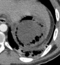 Air in the gastric wall (Courtesy Dr. V. Penopoulos)