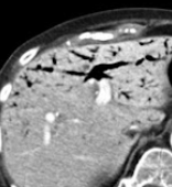Air in the portal venous system (Courtesy Dr. V. Penopoulos)