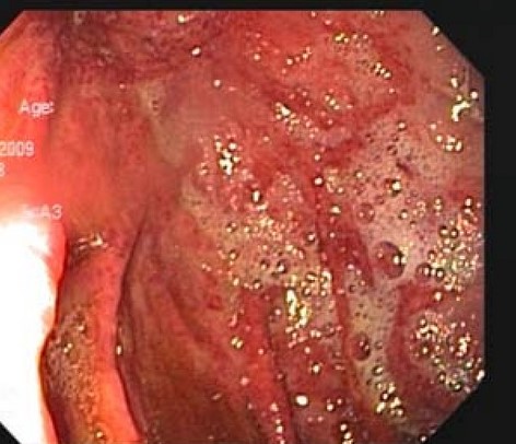 Gastroscopy. Gastric emphysema (Courtesy Dr. V. Penopoulos)