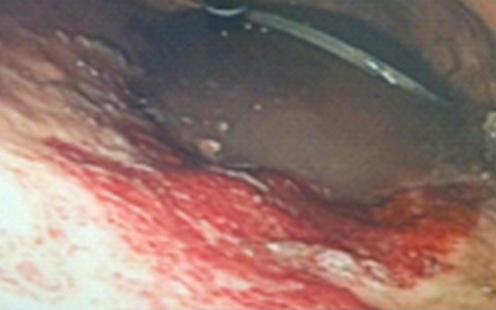 Repeat abdominal CT scan demonstrating complete resorption and disappearance of air from the stomach and the portal venous system (Courtesy Dr. V. Penopoulos)