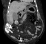 Repeat abdominal CT scan demonstrating complete resorption and disappearance of air from the stomach and the portal venous system (Courtesy Dr. V. Penopoulos)
