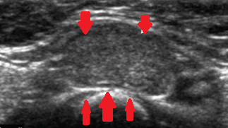 Neck ultrasound. Well-circumscribed nodule corresponding to ectopic thyroid (Courtesy Dr. V. Penopoulos)