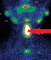Neck MRI. Dual thyroid ectopia (Courtesy Dr. V. Penopoulos)
