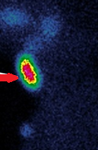 Neck MRI. Dual thyroid ectopia (Courtesy Dr. V. Penopoulos)