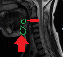 Neck MRI. Dual thyroid ectopia (Courtesy Dr. V. Penopoulos)