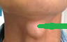 Visible "nodule" in the midline of the neck (Courtesy Dr. V. Penopoulos)