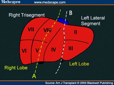 Intussusception of the left hemicolon (Courtesy Dr. V. Penopoulos)
