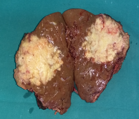 Undifferentiated sarcoma as the cause of the intussusception of the left hemicolon (Courtesy Dr. V. Penopoulos)