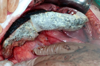 Presence of multiple metastases in the right lobe of the liver, 3 years after left hemicolectomy (Courtesy Dr. V. Penopoulos)