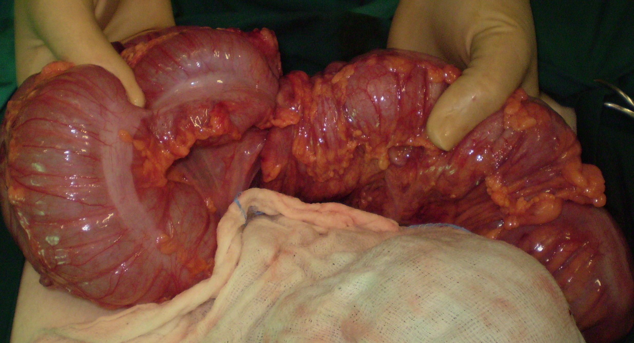 Specimen of trisegmentectomy of the right lobe of the liver (Courtesy Dr. V. Penopoulos)