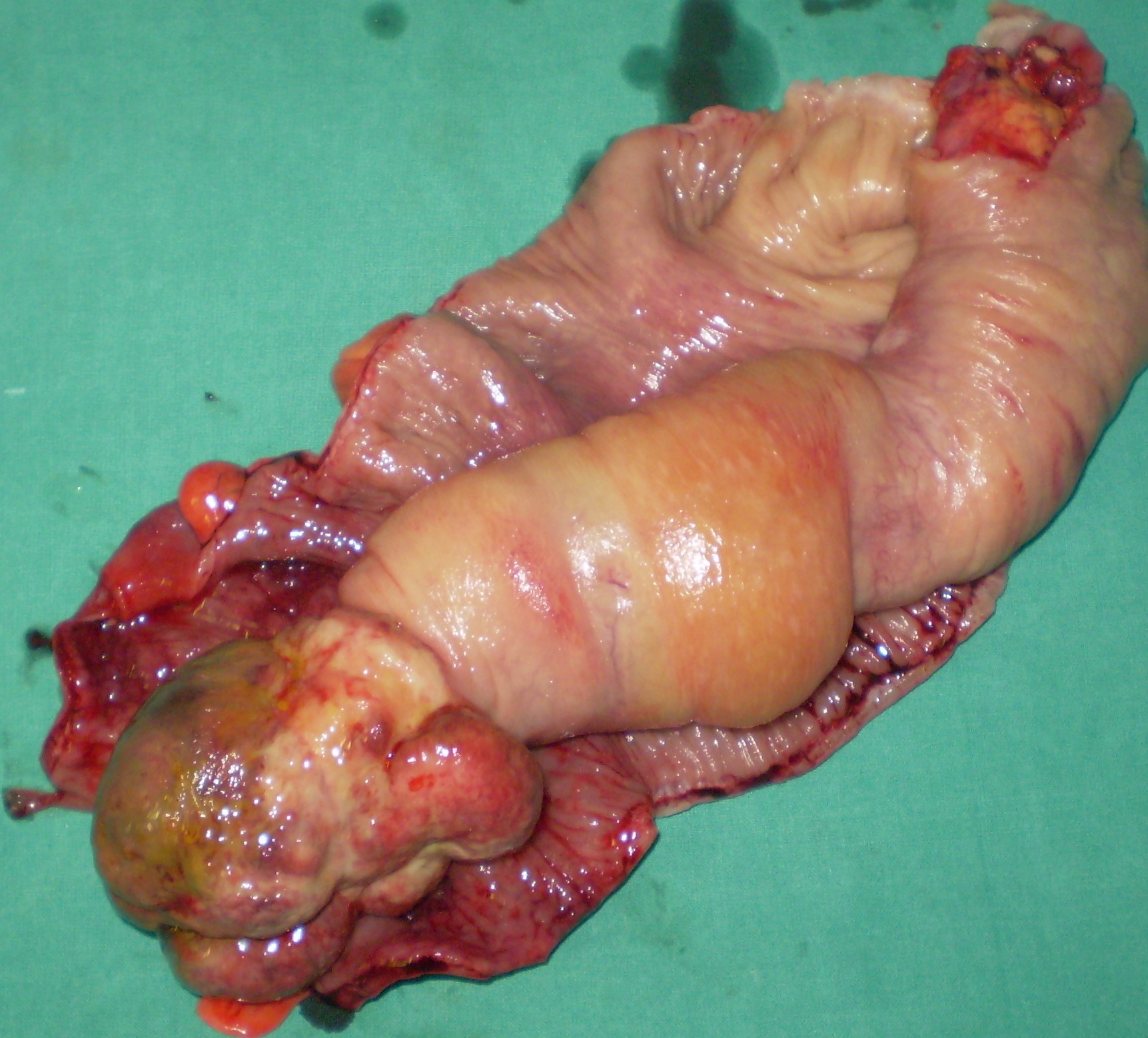 Specimen of trisegmentectomy (Courtesy Dr. V. Penopoulos)