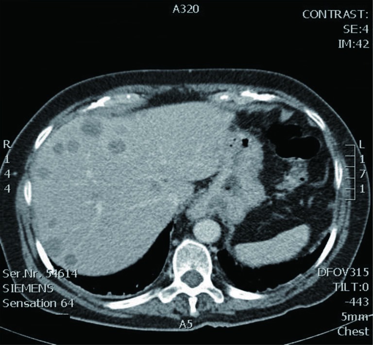 Specimen of trisegmentectomy (Courtesy Dr. V. Penopoulos)