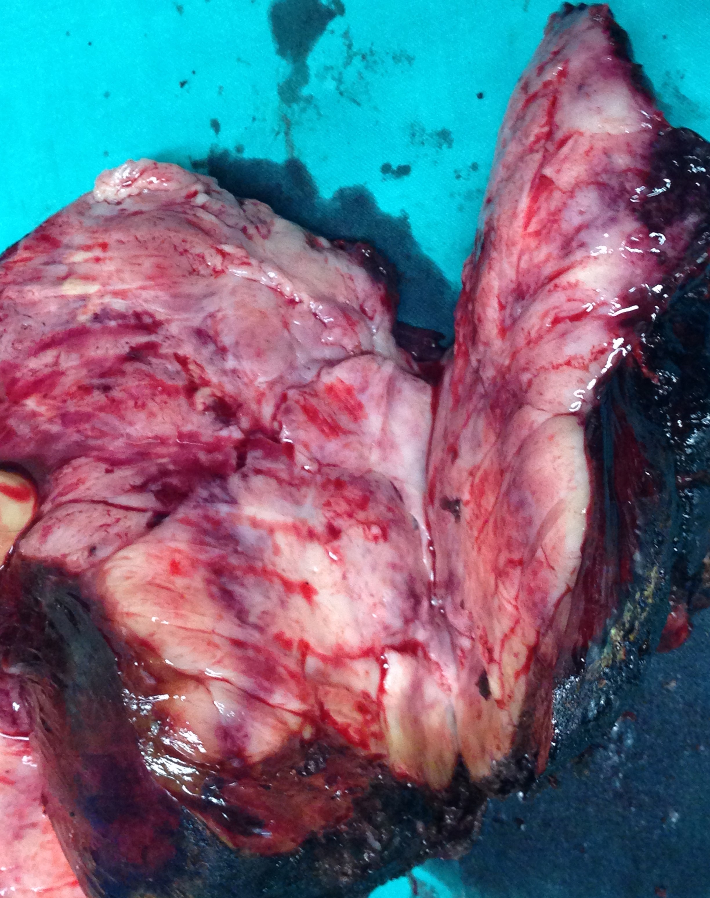 Specimen of trisegmentectomy (Courtesy Dr. V. Penopoulos)