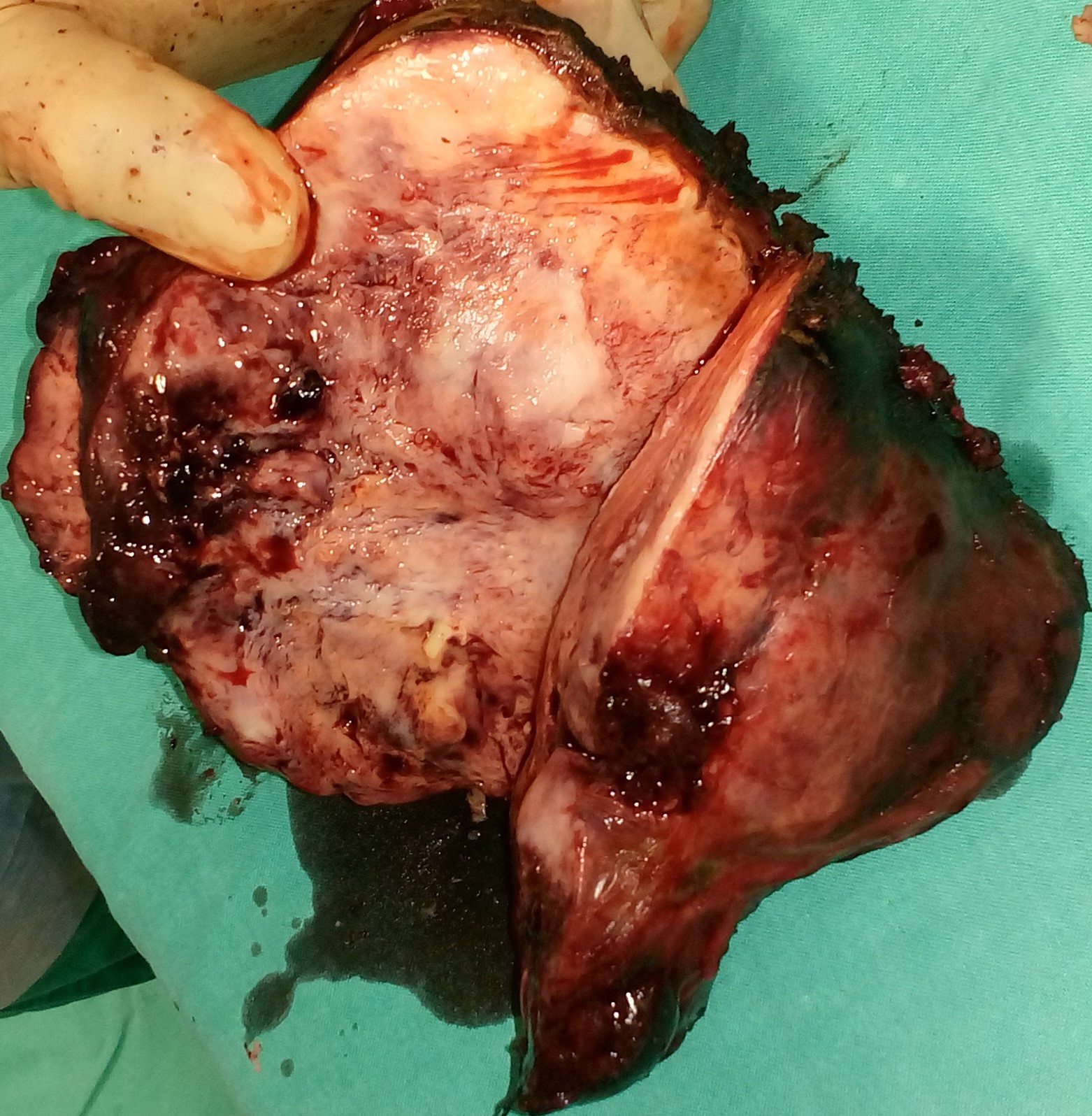 Specimen of trisegmentectomy (Courtesy Dr. V. Penopoulos)