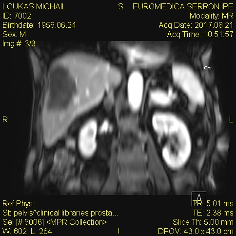 Specimen of abdominoperineal resection for cancer of the anorectal junction (Courtesy Dr. V. Penopoulos)