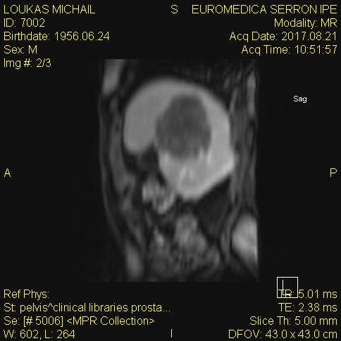 Schematic representation of the fully mobilized liver (Courtesy Dr. V. Penopoulos)