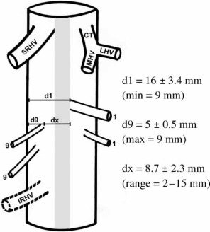 Inferior hepatic vein after completion of the hepatectomy (Courtesy Dr. V. Penopoulos)