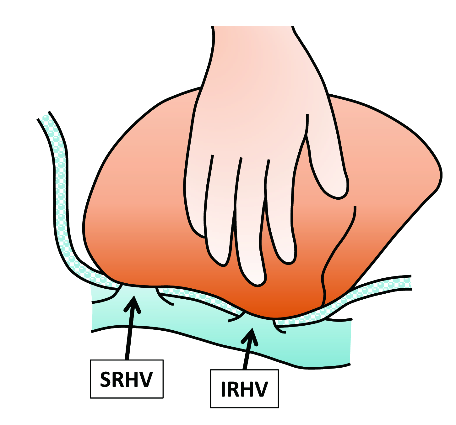 Inferior hepatic vein after completion of the hepatectomy (Courtesy Dr. V. Penopoulos)