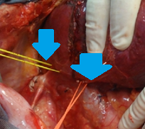Surgical specimen of trisegmentectomy. Weight of resected liver: 578 g (Courtesy Dr. V. Penopoulos)