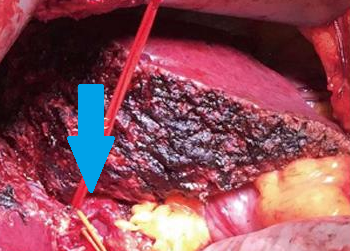 Completion of trisegmentectomy (Courtesy Dr. V. Penopoulos)