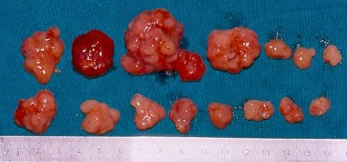 Αφαιρεθέντες πολύποδες, ενδοσκοπικά και χειρουργικά (Ευγενική παραχώρηση Dr. V. Penopoulos)