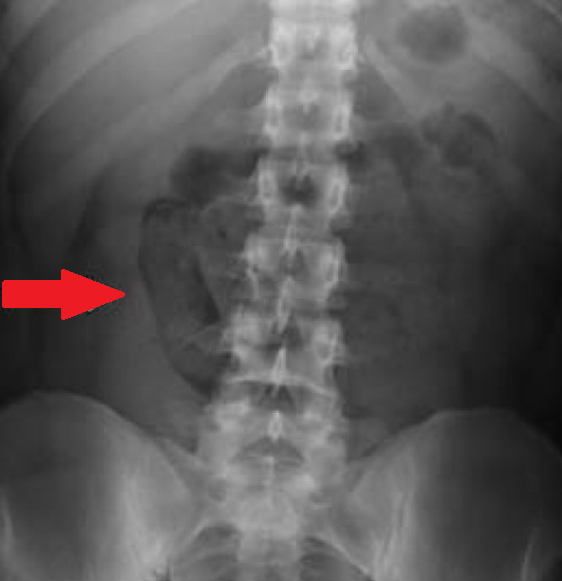 Κλασική υπερηχογραφική εικόνα εντύλιξης λεπτού εντέρου (Ευγενική παραχώρηση Dr. V. Penopoulos)
