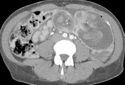 Διεγχειρητική ενδοσκοπική αφαίρεση πολύποδα (Ευγενική παραχώρηση Dr. V. Penopoulos)