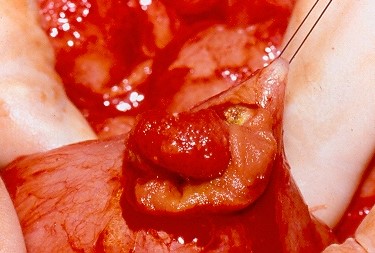 Κακοήθως μετατραπείς πολύποδας ειλεού (Ευγενική παραχώρηση Dr. V. Penopoulos)