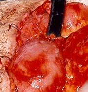 Αφαιρεθέντες πολύποδες, ενδοσκοπικά και χειρουργικά (Ευγενική παραχώρηση Dr. V. Penopoulos)