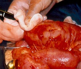 Αφαιρεθέντες πολύποδες, ενδοσκοπικά και χειρουργικά (Ευγενική παραχώρηση Dr. V. Penopoulos)