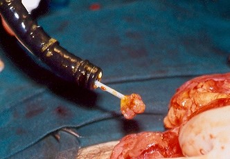 Αφαιρεθέντες πολύποδες, ενδοσκοπικά και χειρουργικά (Ευγενική παραχώρηση Dr. V. Penopoulos)